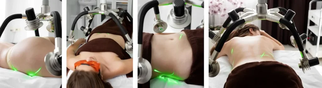 Laserbehandlingar för att förbättra hudens utseende efter cellterapi