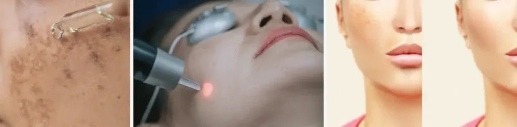 Laserbehandlingar för att minska mörka fläckar på huden