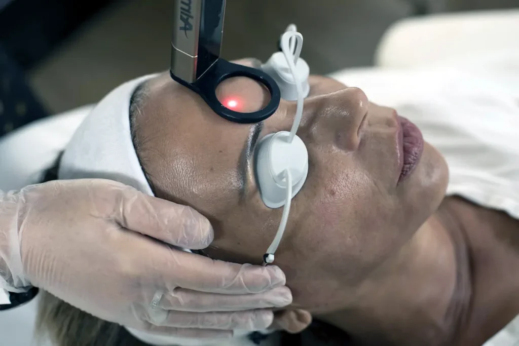 laserbehandlingar för att minska rynkor i pannan