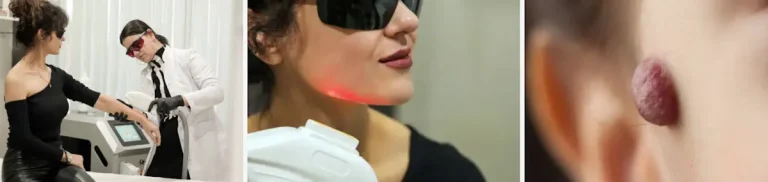 laserbehandlingar för hemangiom