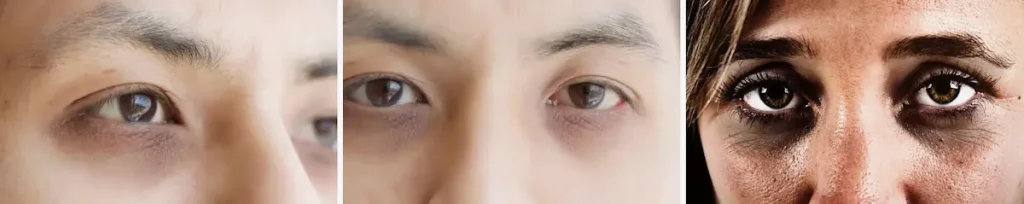 Laserbehandlingar för mörka ringar under ögonen