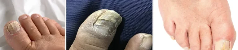 laserbehandlingar för nagelsvamp