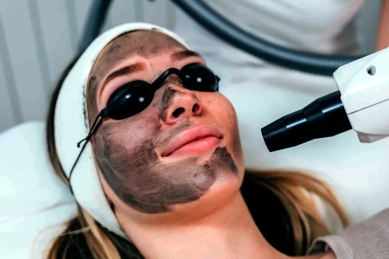 laserbehandlingar för pigmentfläckar