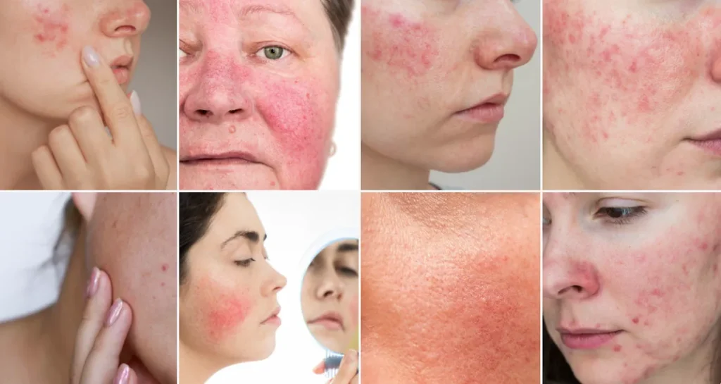 laserbehandlingar för rosacea