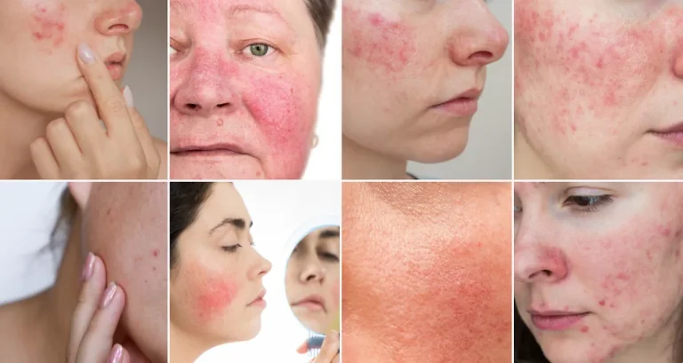 laserbehandlingar för rosacea