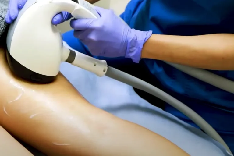 laserbehandlingar vid celluliter