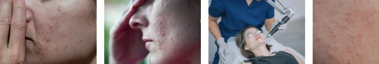 laserbehandlingar vid rosacea