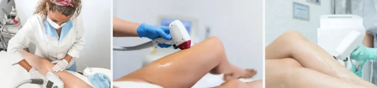 laserbehandlingen vid celluliter