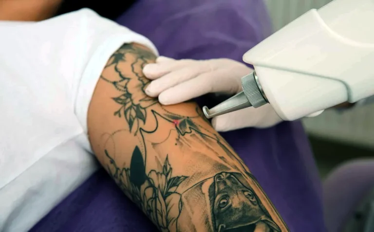 laserborttagning av tatueringar