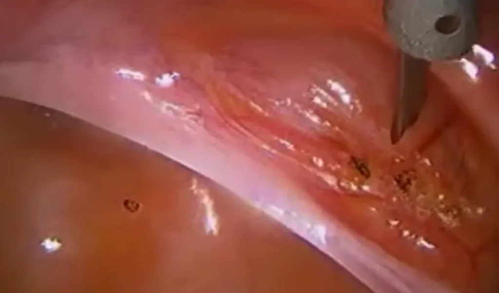 Laserendometrieablation för kraftiga menstruationer