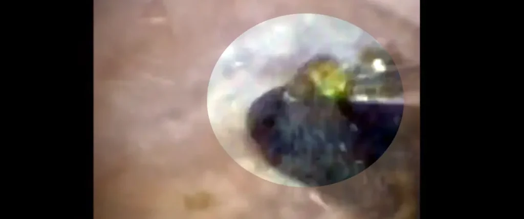 Laserlitotripsi för njursten