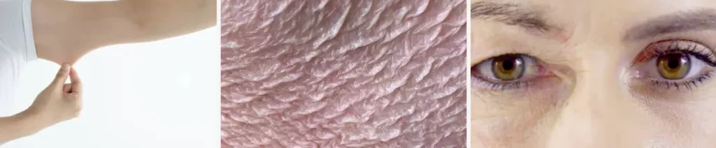 Laseroperationer för att behandla hängande hud