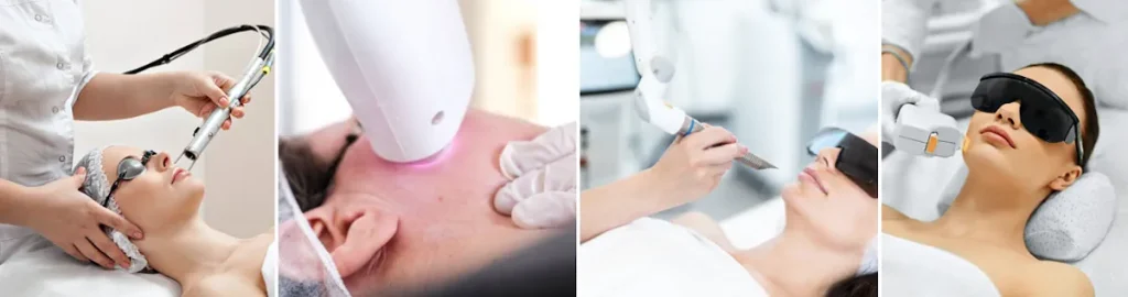 Laseroperationer för att behandla rosacea