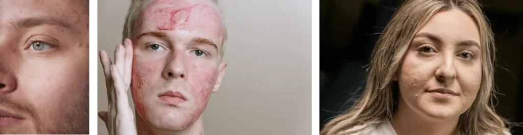 Laseroperationer för att förbättra hudens textur