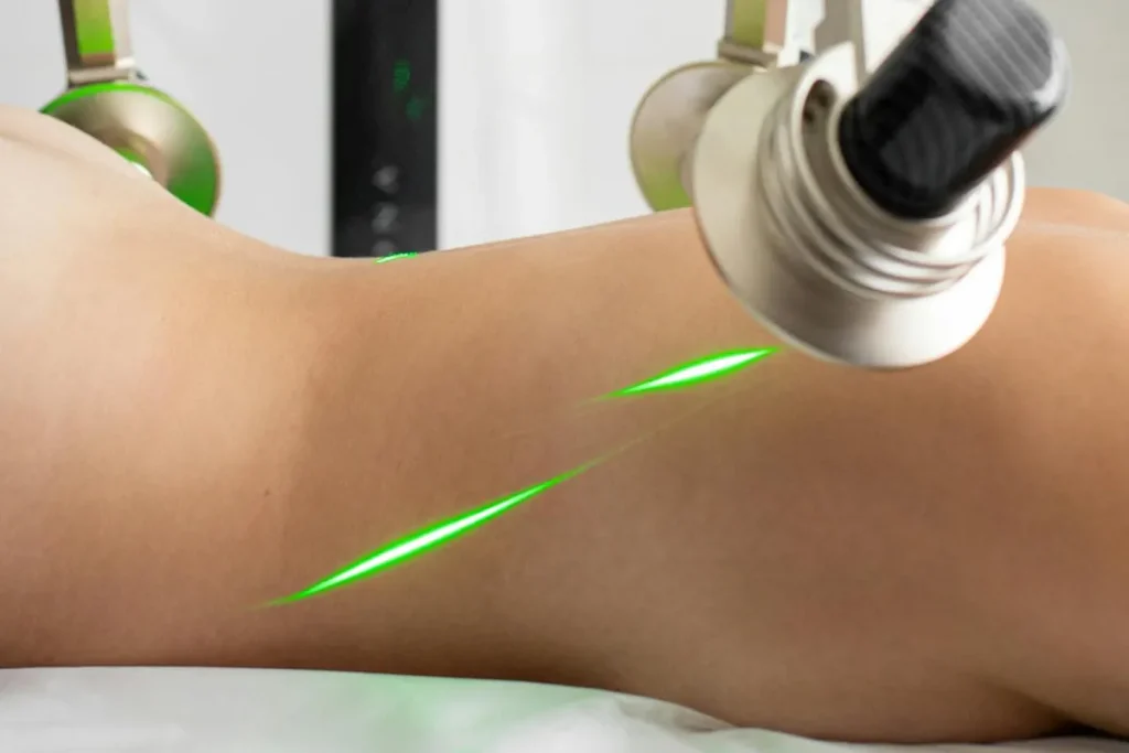 Laseroperationer för att minska kroppsfett