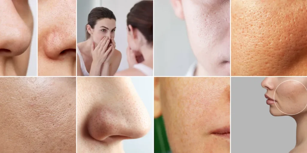 Laseroperationer för att minska porer