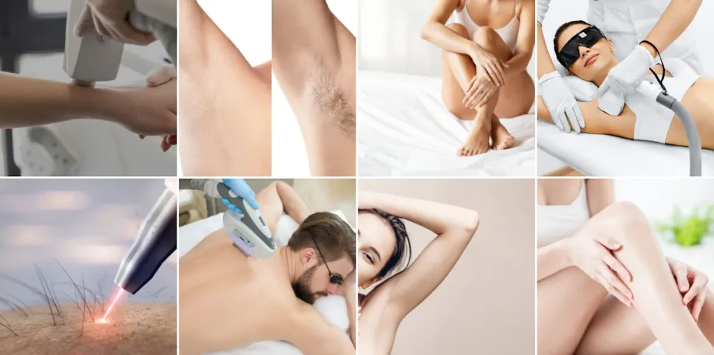 Laseroperationer för hårborttagning