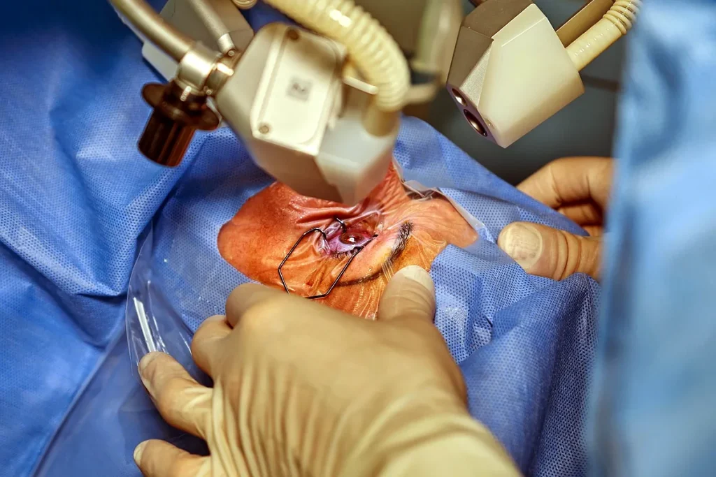 Laseroperationer för ögon