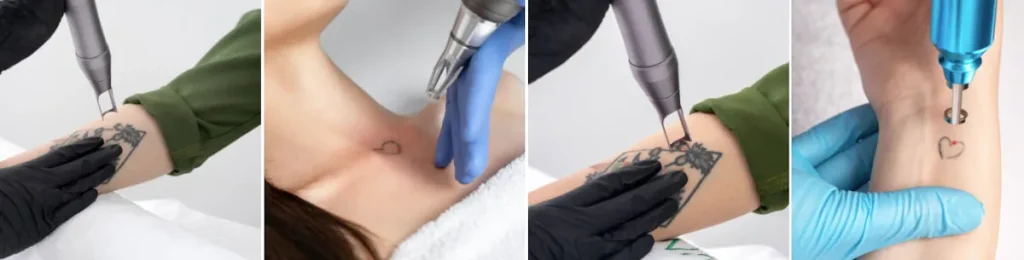 Laseroperationer för tatueringsborttagning