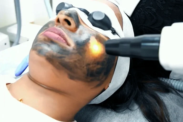 laserpeeling