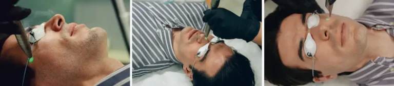 laserpeeling av man