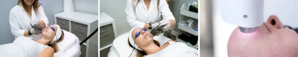 Lasrar som används för skönhetsbehandlingar