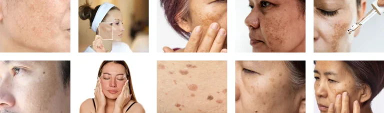 melasma