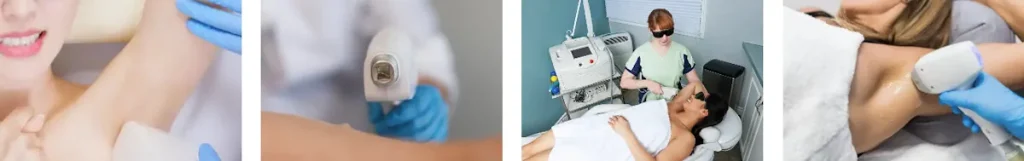 Minskad förmåga att svettas på behandlat område efter laserbehandling