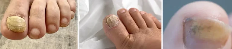 nagelsvamp