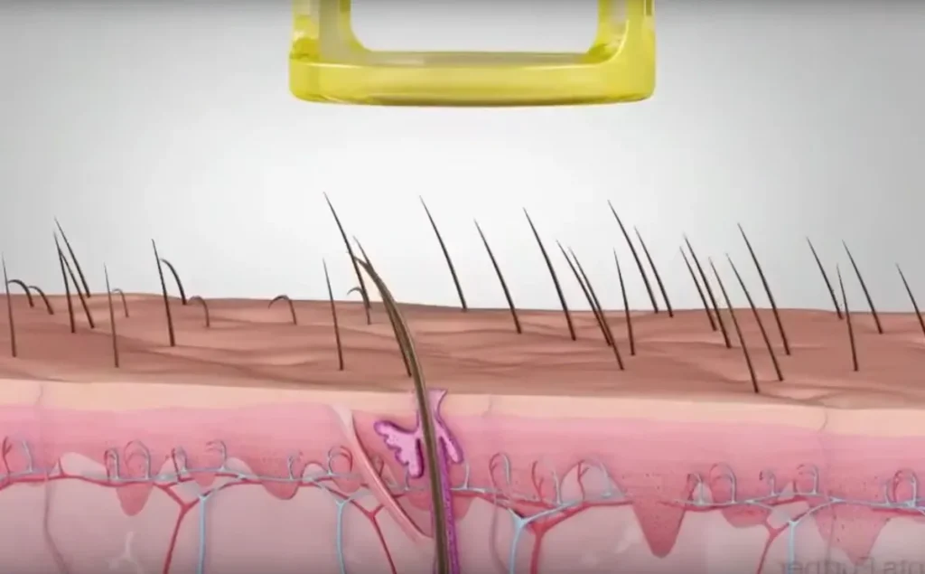 Nervskada efter laserbehandling