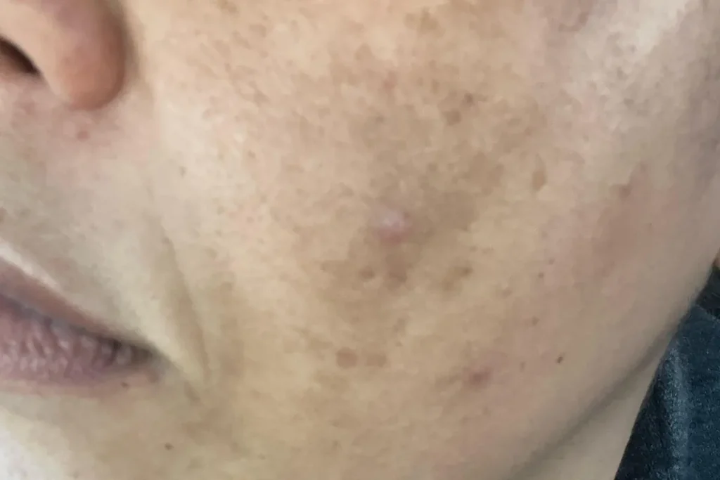 onormal hudfärgning efter laserbehandling