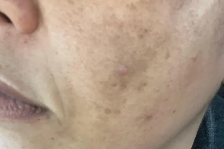 onormal hudfärgning efter laserbehandling