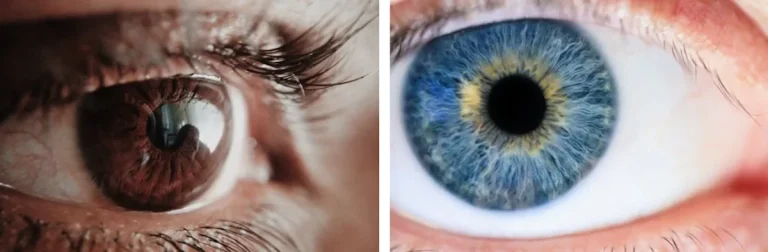 Photorefractive Keratectomy (PRK)