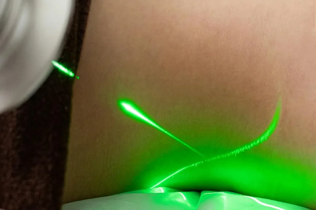 Risker förknippade med laseroperationer