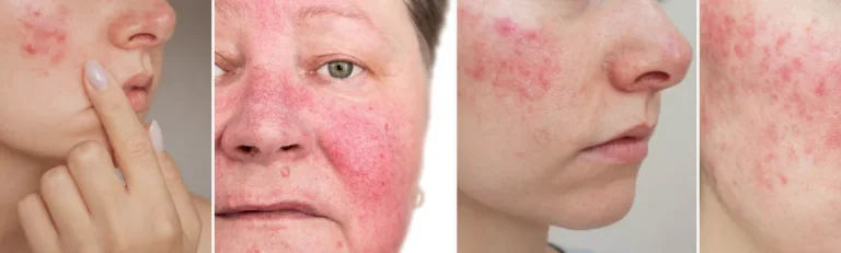 riskerna med laserbehandlingar för rosacea
