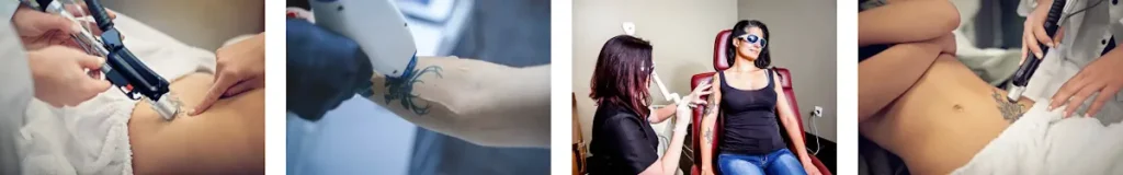 Rubinlaser för borttagning av tatueringar