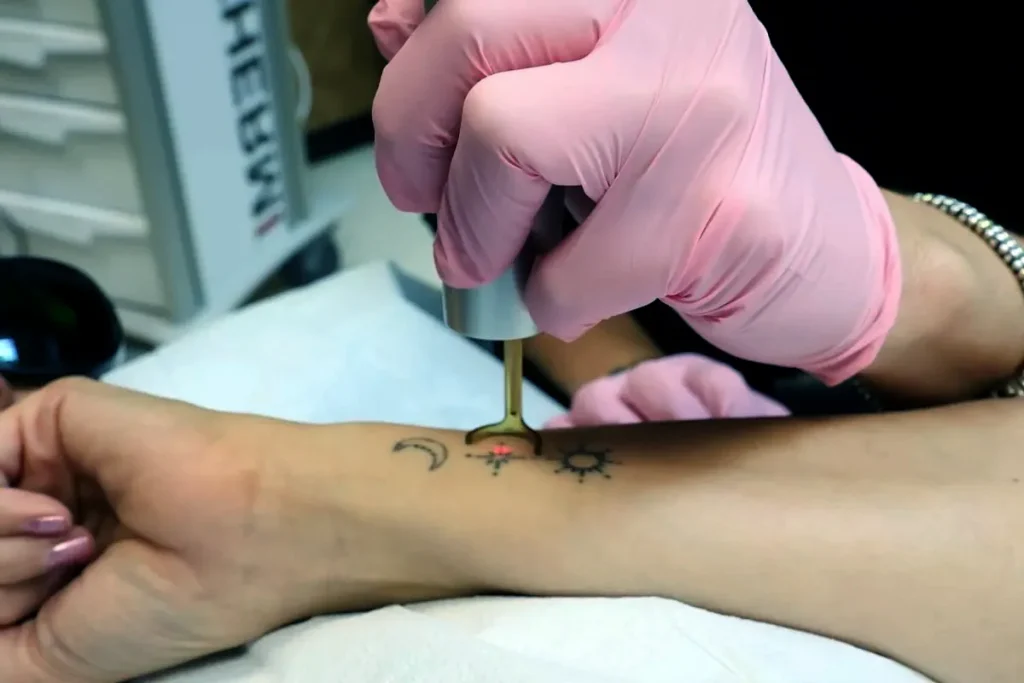 session för att ta bort en tatuering