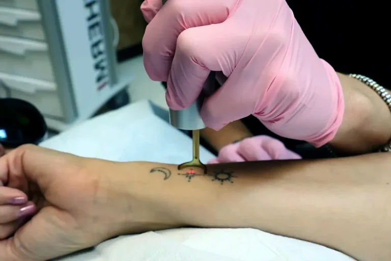 session för att ta bort en tatuering