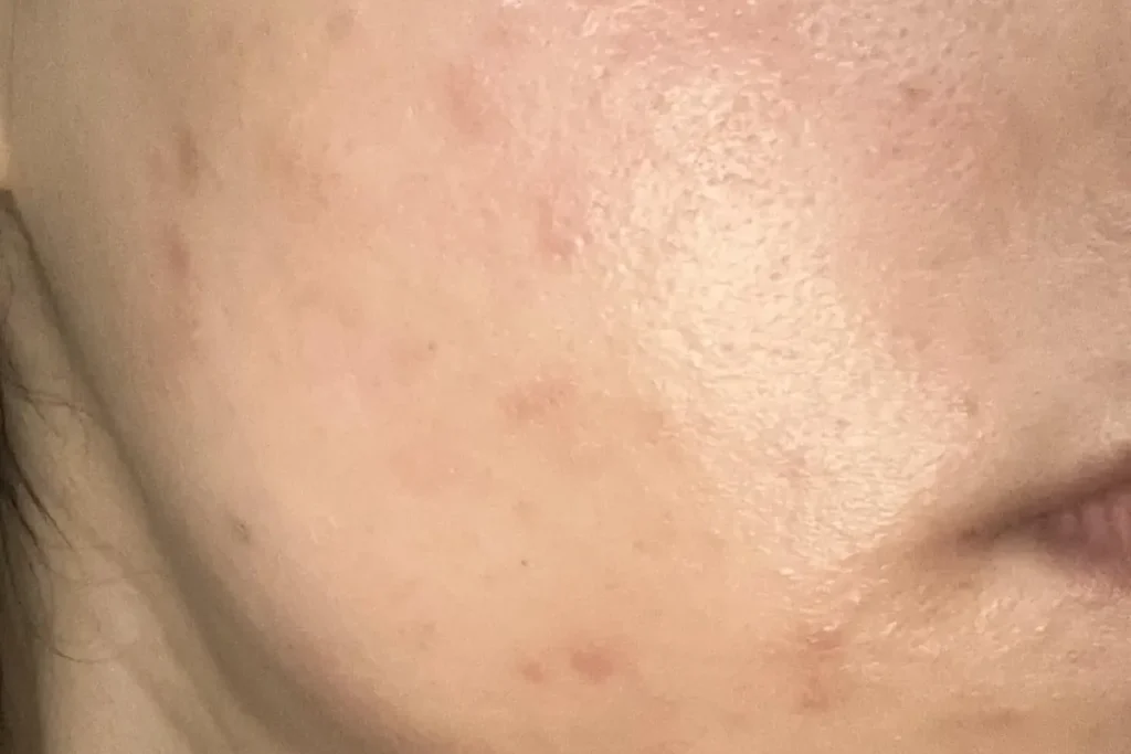 Små knölar eller cystor under huden efter laserbehandling