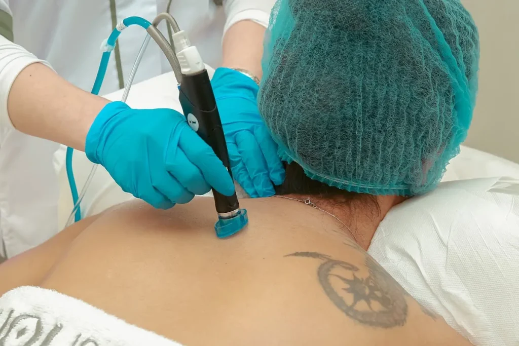 Smärta och obehag efter laserbehandling