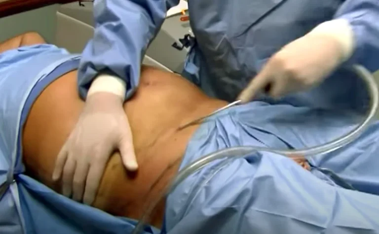 SmartLipo