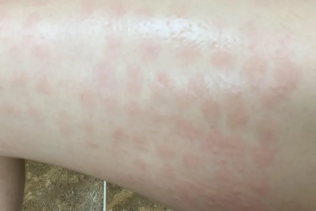 Svullnad efter laserbehandling