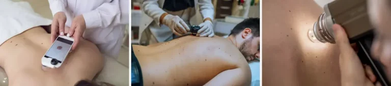 vad bör man undvika efter en laserbehandling för hudcancer