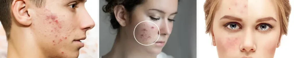 vilka är riskerna med laserbehandlingar för akne