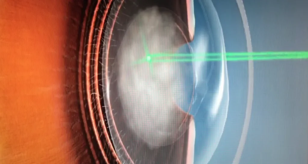 YAG-laser kapsulotomi