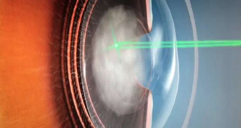 YAG-laser kapsulotomi