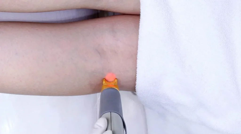 Laseroperationer för åderbråck