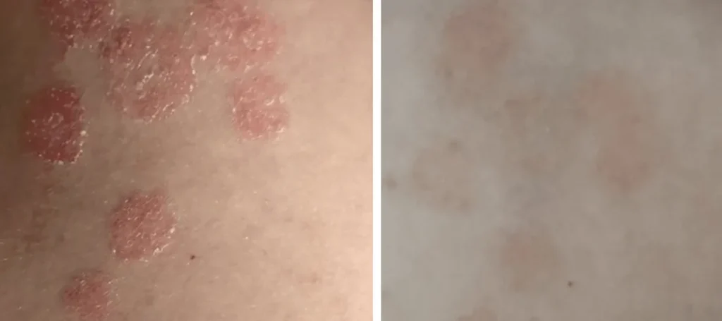 Användning av laser för att behandla psoriasis