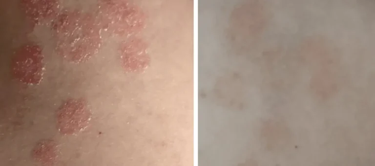 Användning av laser för att behandla psoriasis