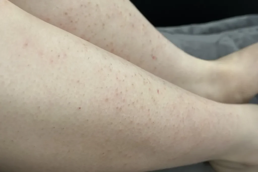 Hudutslag efter laserbehandling